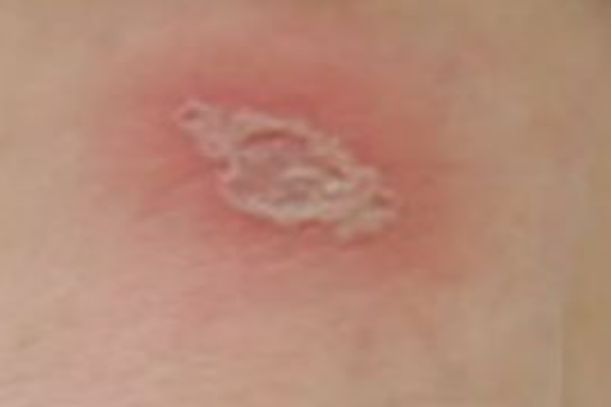 �����ҧ�˺�����ͼƬ��֢״һ��