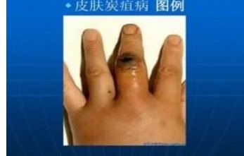 ̿�Ҳ���ʲô����ʲô֢״