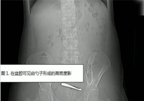 �Ŀ���ࣺ�Ͼ�һС�︹ʹCT���������2������ ֱ������ʱû���